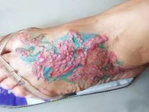 Information About Allergic Reactions Caused By Tattoo Ink